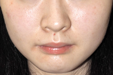 症例1　えら（小顔）ボトックス 施術後（40日経過）