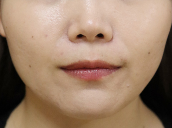 症例3　えら（小顔）ボトックスと脂肪溶解注射 治療後