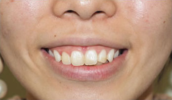 症例1　ガミースマイルボトックス 手術前