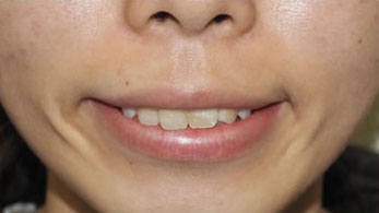 症例1　ガミースマイルボトックス 手術後