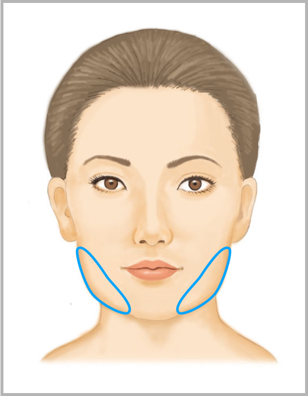 えら（小顔）ボトックス