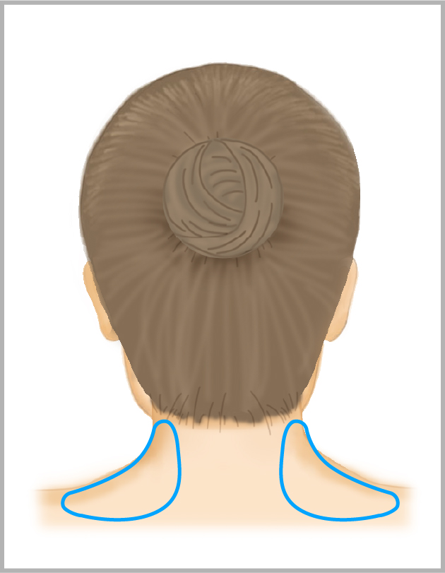 肩やせ・肩こりボトックス