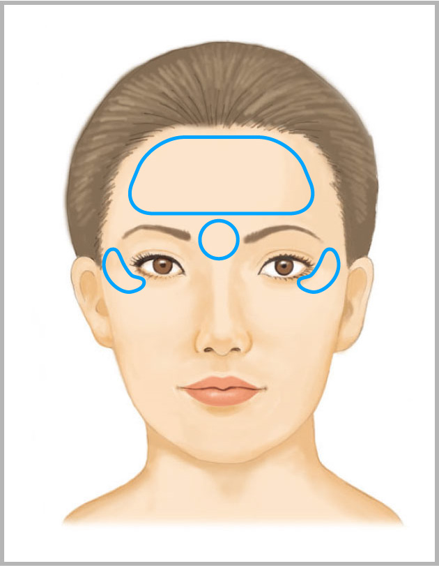 しわ　ボトックス