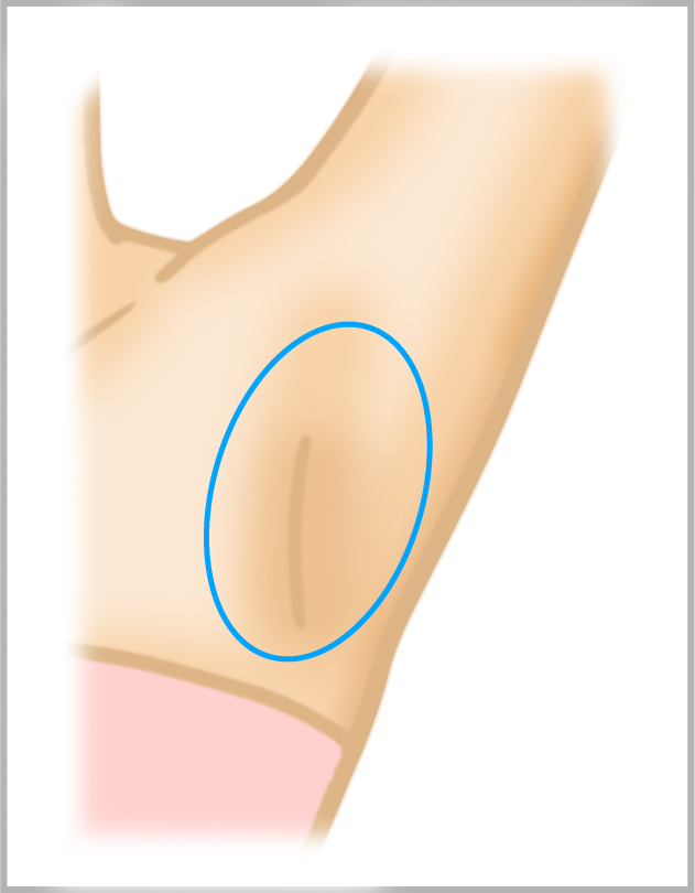 わき多汗ボトックス