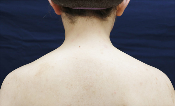 症例1　肩やせボトックス 手術前