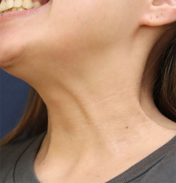 症例1　ボトックスリフト 施術前