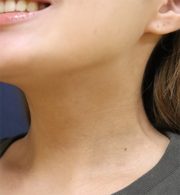 症例1　ボトックスリフト 施術後