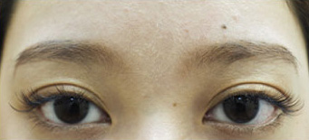 症例1　しわボトックス（眉間） 施術前