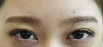 症例1　しわボトックス（眉間） 施術後表情あり