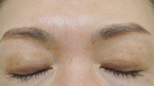 症例2　しわボトックス（眉間） 施術前