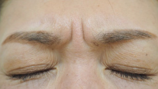 症例2　しわボトックス（眉間） 施術前表情あり