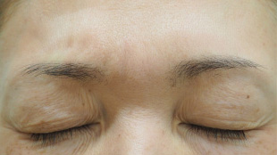 症例2　しわボトックス（眉間） 施術後表情あり