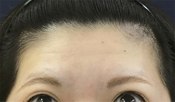 症例3　しわボトックス（おでこ（額）） 施術前