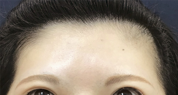 症例3　しわボトックス（おでこ（額）） 施術後