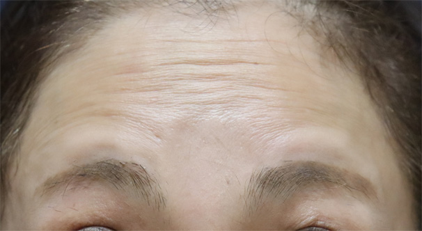 症例4　しわボトックス（おでこ（額）） 施術前