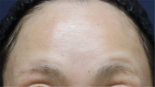 症例4　しわボトックス（おでこ（額）） 施術後