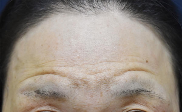 症例5　しわボトックス（おでこ（額）） 施術後