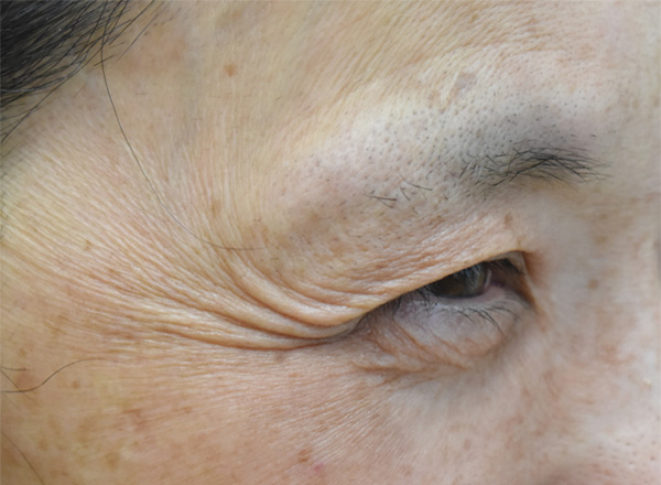 症例6　しわボトックス（目尻） 施術前