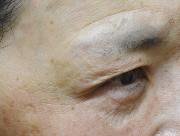 症例6　しわボトックス（目尻） 施術後