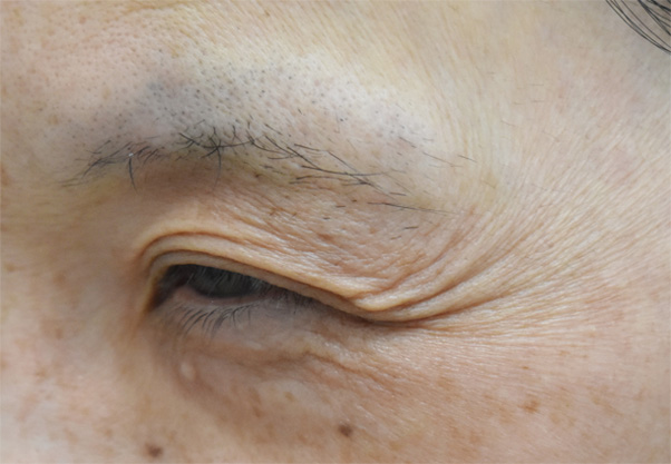 症例6　しわボトックス（目尻） 施術前