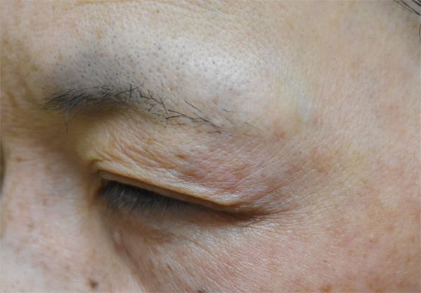 症例6　しわボトックス（目尻） 施術後