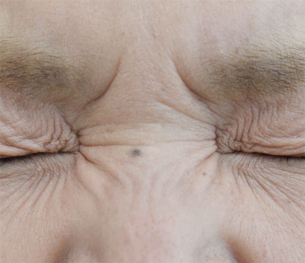 症例7　しわボトックス（鼻根部） 施術前