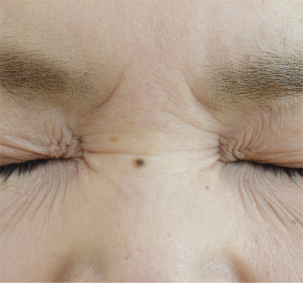 症例7　しわボトックス（鼻根部） 施術後