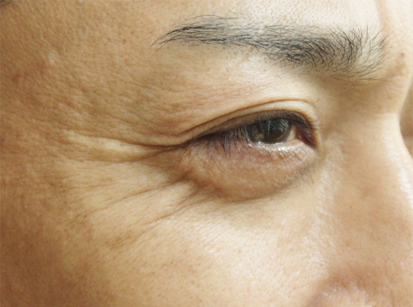 症例7　しわボトックス（目尻） 施術前