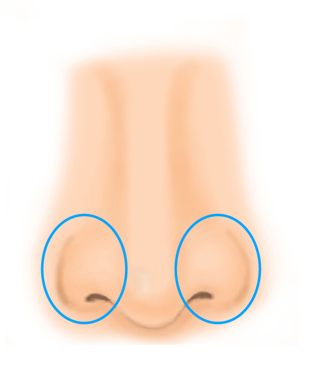 小鼻縮小ボトックス（鼻の穴の大きさ、ふくらみの改善）