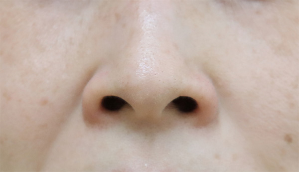 症例1　小鼻縮小ボトックス 施術前