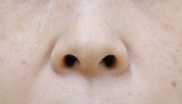 症例1　小鼻縮小ボトックス 施術後