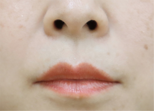 症例2　口角ボトックス 施術前
