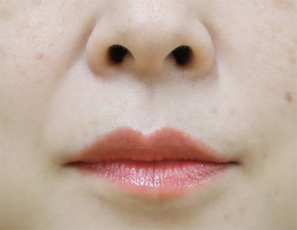 症例2　口角ボトックス 施術後