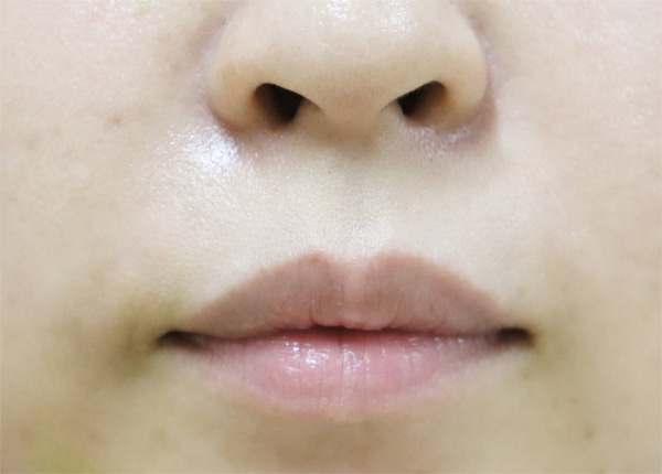 症例3　口角ボトックス 施術後