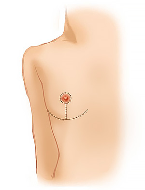 男性化希望の乳房切除術（性別適合手術）2