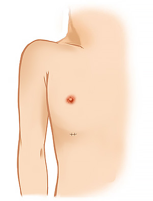 脂肪吸引術（男性の女性化乳房）2