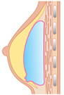 インプラント破損・漏出2