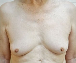症例29　女性化を望む男性の豊胸術（200ml） 手術前