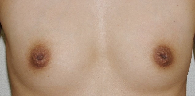 症例3　陥没乳頭修正術 手術前