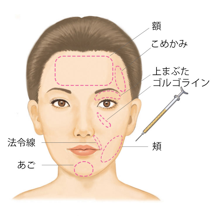 顔への脂肪注入が行える部位
