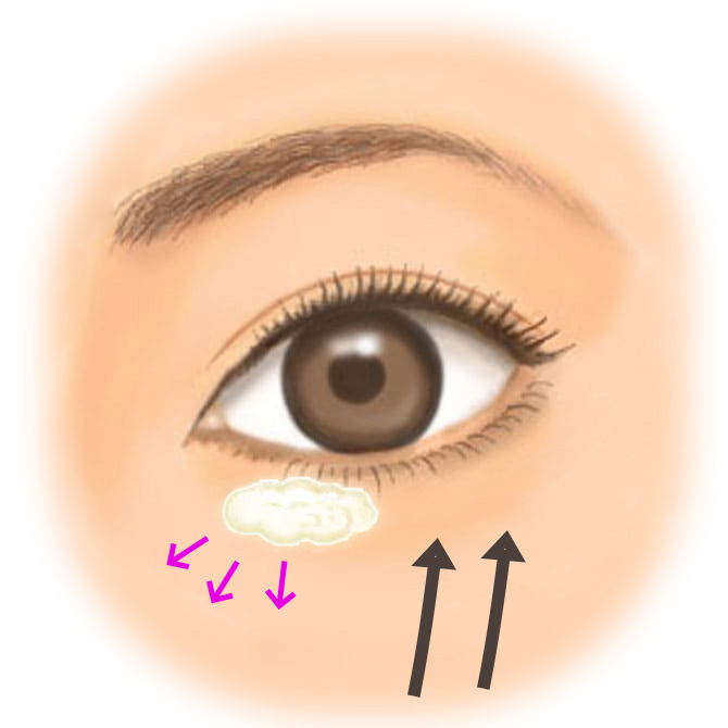 裏ハムラ法＋ミッドフェイスリフト