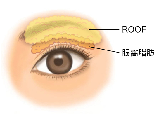 ROOFと眼窩脂肪の位置関係