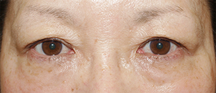症例10　上・下まぶたのたるみ手術 手術前