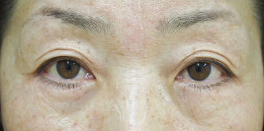 症例16　下まぶたのたるみ手術 手術後