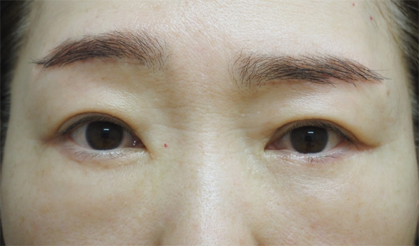 症例18　下まぶたのたるみ⼿術（表ハムラ法）・上まぶたのたるみ手術（眉毛下切開） 手術後