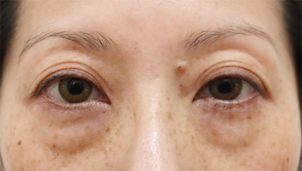 症例19　下まぶたのたるみ⼿術 手術前