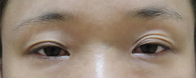 症例9　眼瞼下垂 手術前