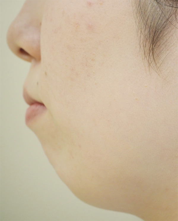 あごが引っ込んでいて口元が出ている方（口ゴボ）へのヒアルロン酸注射 手術前