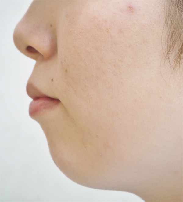 あごが引っ込んでいて口元が出ている方（口ゴボ）へのヒアルロン酸注射 手術後