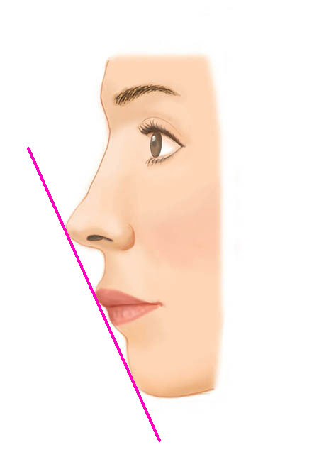 口角挙上（スマイルリップ）Before